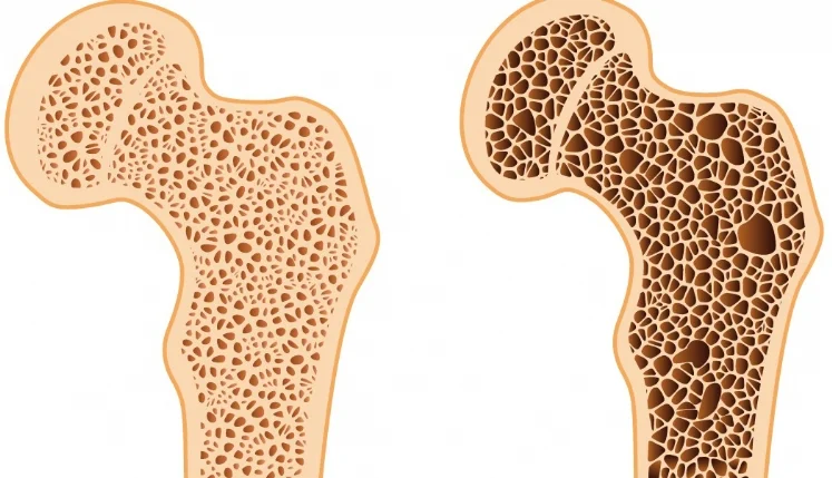 Osteoporose: prevenção, novos medicamentos e avanços no tratamento